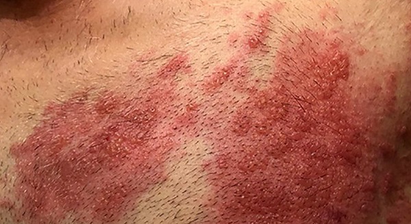 Aman dikkat! Covid-19'dan sonra bu hastalıklar coştu