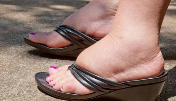 Aman dikkat! Sizin de ayaklarınız sık sık şişiyor mu?