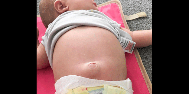 Aman dikkat, uzmanlar uyarıyor! Göbek fıtığı olabilirsiniz