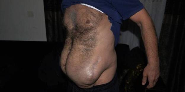 Ameliyat sonrası hayatı karardı! İçeride unutulan şey şok etti