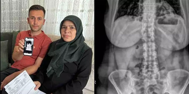 Ameliyatta karnında unutulan makasla 8 ay yaşadı!