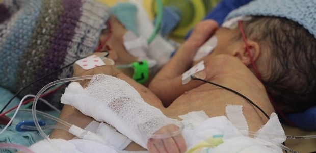 8 günlük yapışık ikizler amaliyatla ayrıldı