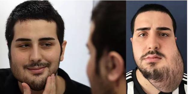 Ankara'da tarihe geçen operasyon: Yüzünün yarısı alındı, bacağından yeni yüz yapıldı