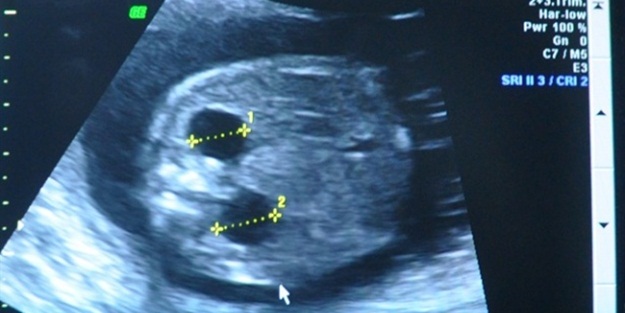 Anne karnında ameliyat edilen bebek doğdu