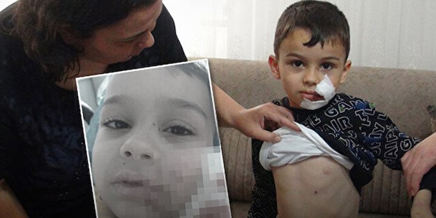 Annesiyle parka giden küçük çocuğun yüzünden parça kopardı! Çocuk parkında başıboş köpek beslenmez!