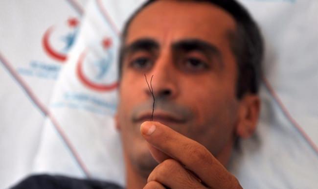 Antalya’da karın ağrısı diye gitti bağırsağından tel çıktı