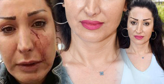 Antalya'da 'patatesi değiştir' dedi, garson yüzüne bıçak fırlattı