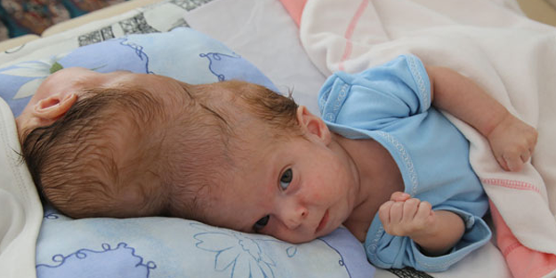 Antalyalı siyam ikizleri ayrılmak için gün sayıyor!