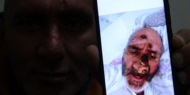 Antalya'ya çalışmaya giden işçinin hayatı sinek ısırması ile kabusa döndü!