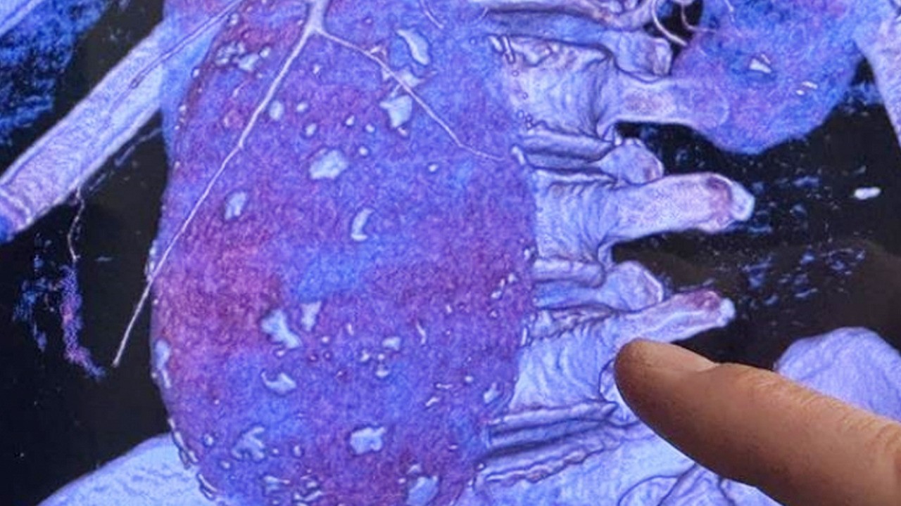 Aort damarı ve kalp sağlığını korumada basit değişimler can suyu olacak! Öne çıkıyor