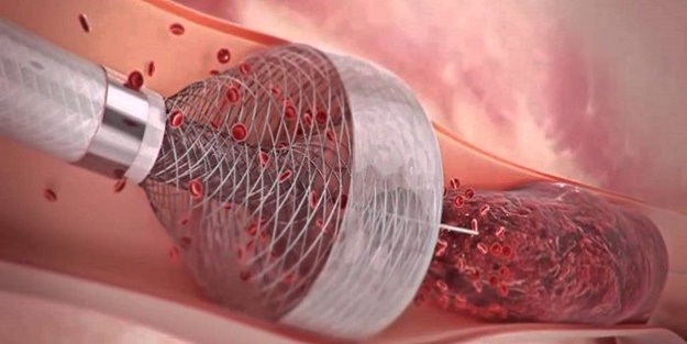 Atardamar tıkanıklığı nedir?