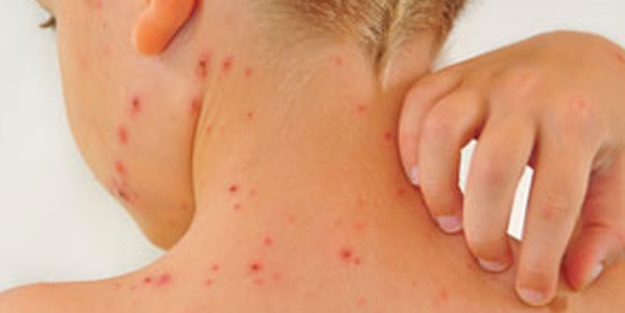 Avrupa bu hastalıkla sarsıldı: 35 çocuk öldü