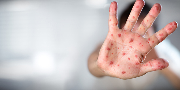 Avrupa'da hızla yayılıyor! Maymun çiçeği virüsü bir ülkede daha görüldü