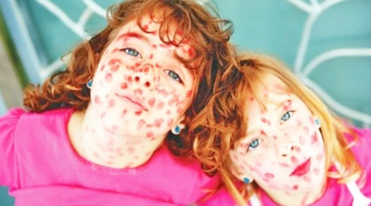 Avrupa’da kızımak vakalarında ani artış: Sınır komşumuz nüfusun aşılanması kararı aldı