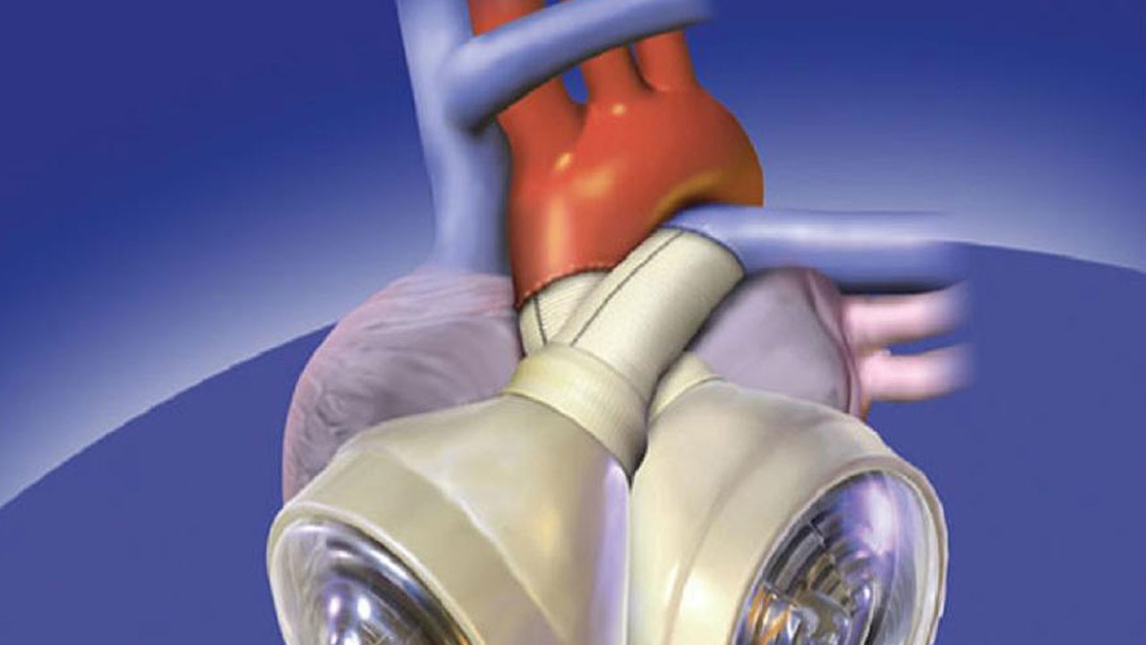 Avustralya’da tıp tarihine geçen başarı: Yapay kalple 100 gün hayatta kaldı!