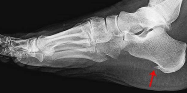 Ayağınızdaki ağrının sebebi topuk dikeni olabilir!