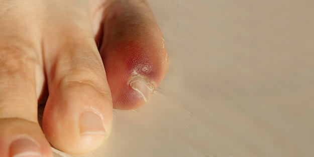 Ayak kararması nasıl geçer?