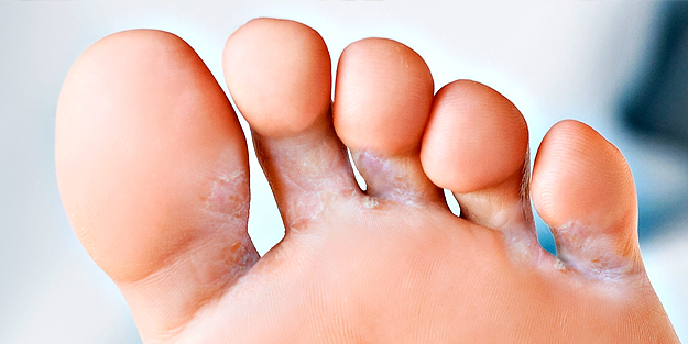 Ayak mantarı kimyasal kullanmadan da tedavi edilebilir