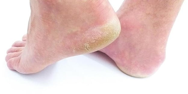 Ayak mantarı nasıl geçer? Ayak mantarına ne iyi gelir?