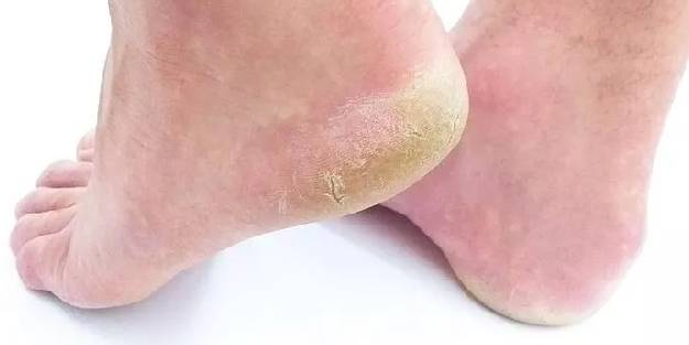 Ayak mantarına ne iyi gelir?