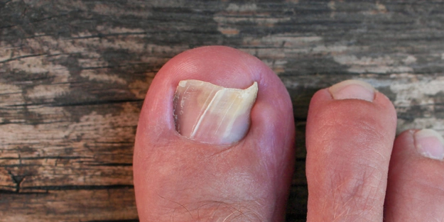 Ayak mantarından ve ayak kokusundan kurtulun