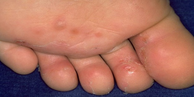 Ayak mantarınız mı var? İşte kurtulmanın yolları