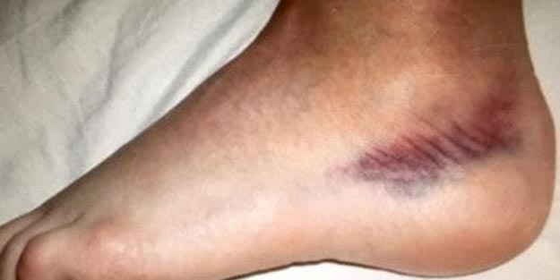 Ayak morarması ve şişmesine ne iyi gelir