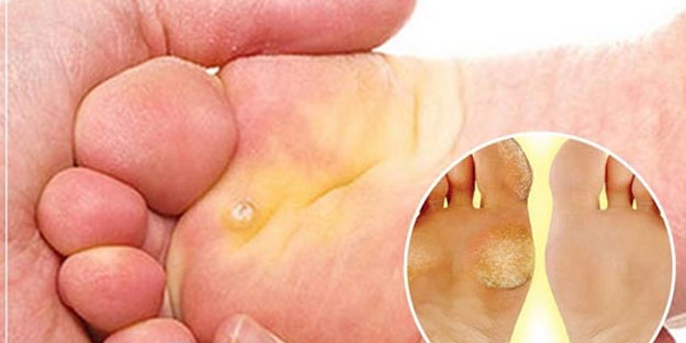 Ayak nasırlarına bitkisel çözümler: Ayak nasırı tarihe karışacak! Hiç böyle görmediniz