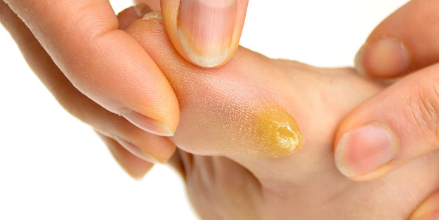 Ayak nasırlarına bitkisel çözümler: Vatandaş tedirgin ama bu yeni fırsatlar doğurabilir! Değerli kılan ölçü