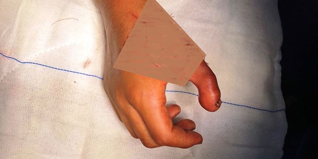 Ayak parmağı eline nakledildi