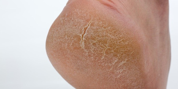 Ayak topuklarındaki çatlakları yumuşatan yöntem