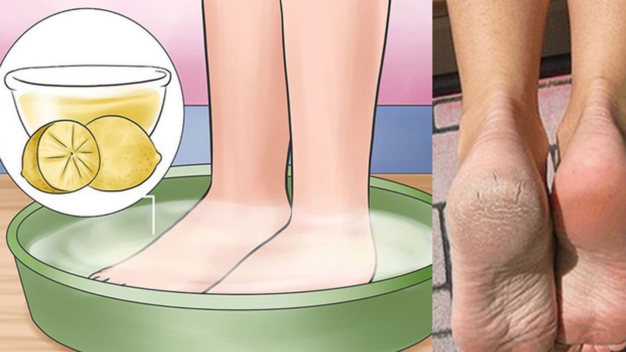 Ayaklardaki nasırları yok edecek en etkili yöntem ne diyenler: İlaç kullanan bir daha tekrar düşünsün!