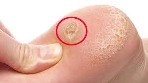 Ayaklardaki nasırları yok edecek en etkili yöntem: Yeniden güçlendirilmeli! Nasırı kökünden söken destek