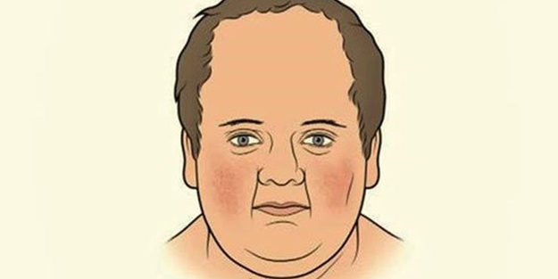 Aydede Sendromu nedir?