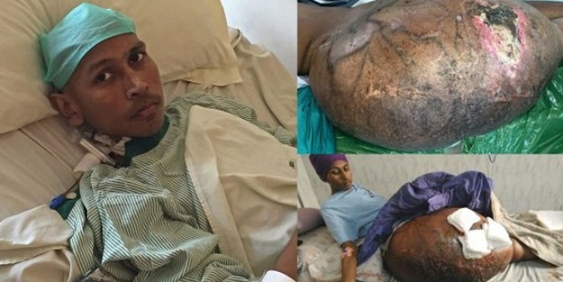 Bacağından 55 kiloluk tümör çıktı