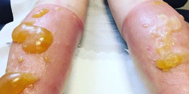 Bacakları bu hale geldi