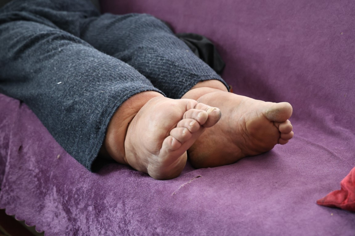 Bacakları tam 80 cm çapına ulaştı! Hastalığın tedavisi yok