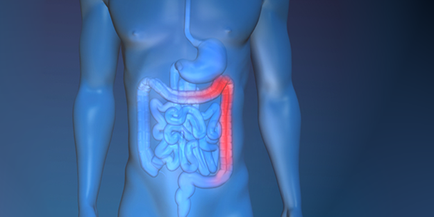 Bağırsak kanseri nasıl tedavi edilir?