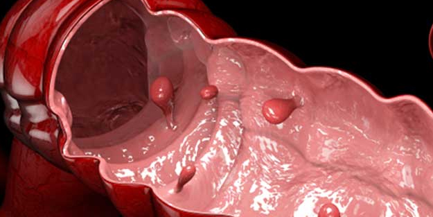 Bağırsaklarınızı doğduğunuz gün kadar temiz yapacak karışım! Bunu yapan herkes memnun