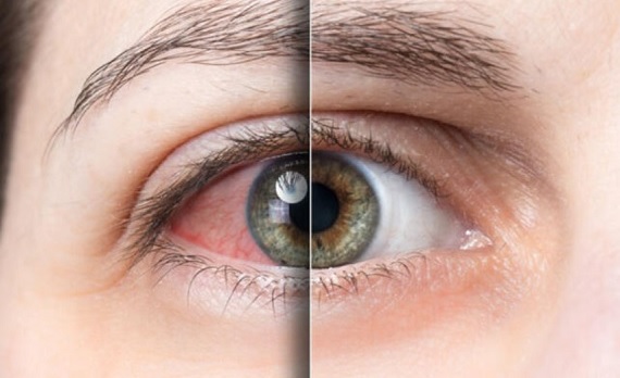 Bahar geldi, bu belirtilere dikkat! Alerjisi olanlar mutlaka bunu yapmalı