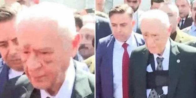 Bahçeli'nin yüzündeki morlukların sebebi belli oldu! Kahreden haber
