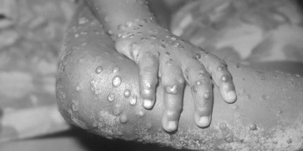 Bakan Koca'dan flaş 'maymun çiçeği' virüsü açıklaması!