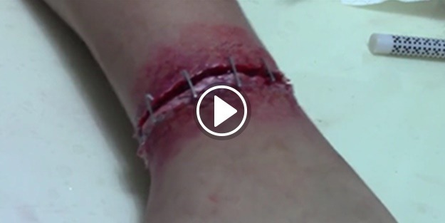 Bakın koluna ne yaptı!