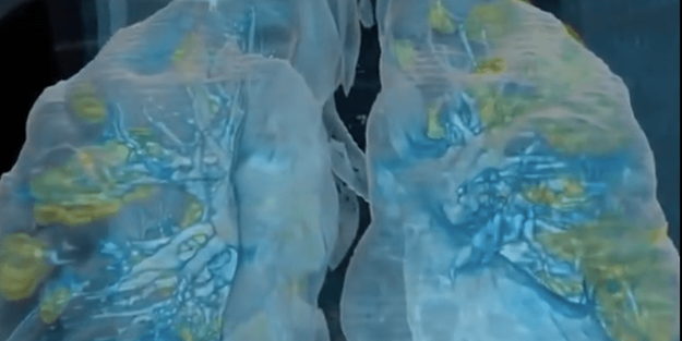 Bakın neler yapıyor! İşte koronavirüs bulaşan kişinin akciğerleri