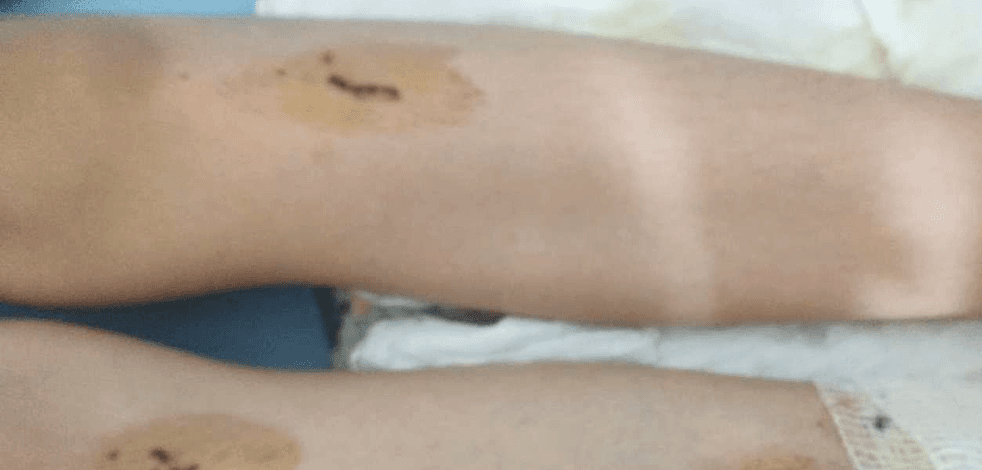Balkona atılan torpilin patlaması sonucu 12 yaşındaki çocuk yaralandı
