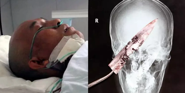 Baş ağrısı çeken adam, 4 yıldır kafasında paslı bıçak olduğunu öğrendi!