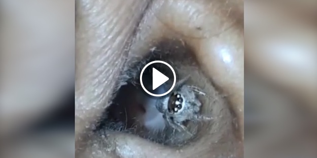 Baş ağrısıyla doktora gitti, kulağından örümcek çıktı!