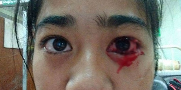 Başı ağrıyınca gözlerinden kan geliyor!