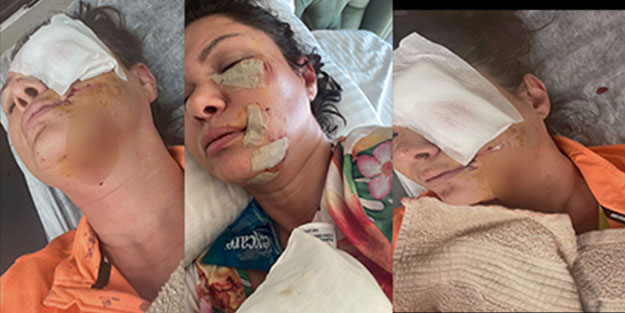 Başıboş köpeklere önlem alınmasına karşıydı... Başıboş köpek ünlü ismin yüzünü parçaladı!