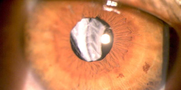 Başından darbe alan birinin gözüne neden ışık tutulur?